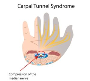 Physiotherapy for Hand, Wrist and Finger Injuries - Glebe Physio