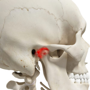 Physiotherapy for Jaw Pain – The Temporomandibular Joint - Glebe Physio