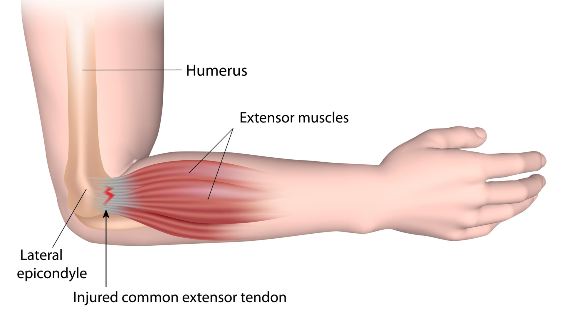 Physiotherapy For Elbow And Forearm Pain Glebe Physio   Basic Anatomy Of Tennis Elbow 