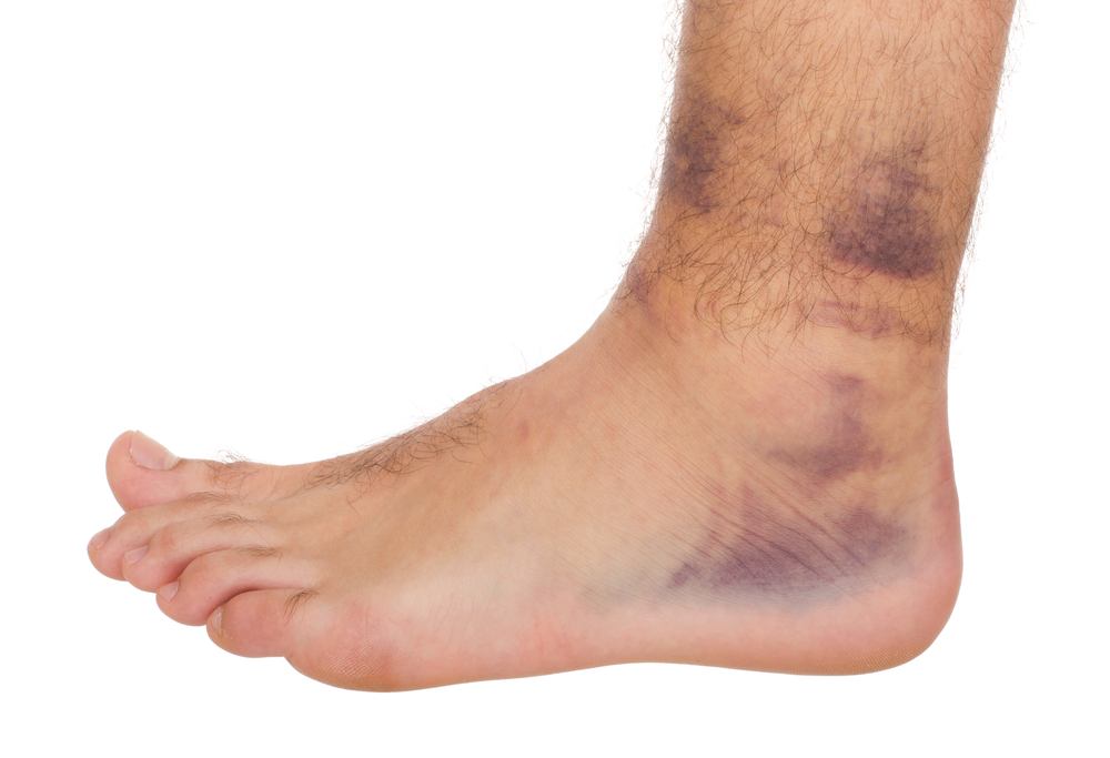 Physiotherapy for Ankle Pain - Glebe Physio