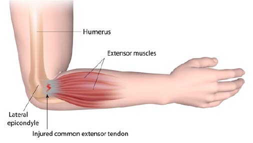 Injury Update: Tennis Elbow